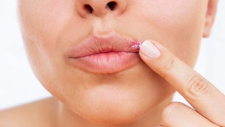 Herpes Simplex- Bagaimana Cara Penularannya.jpg