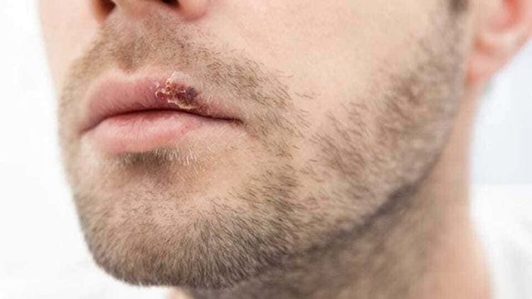 Herpes Simplex, Bagaimana Pengobatannya.jpg