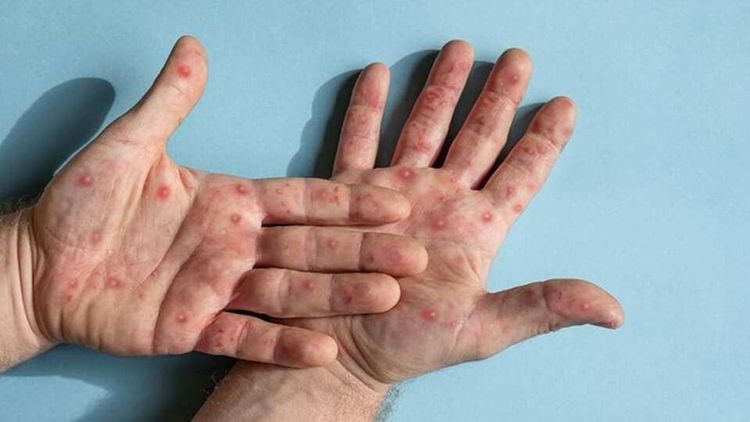 Mengenal Cacar Monyet (Mpox) dan Cara Penularannya