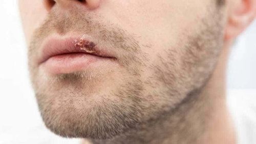 Herpes Simplex: Bagaimana Pengobatannya?